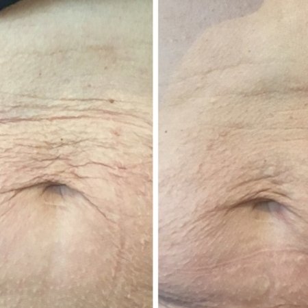 be-lifted-plasma-resultaten-1