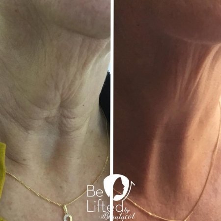 be-lifted-plasma-resultaten-10