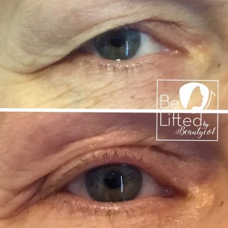 be-lifted-plasma-resultaten- 4